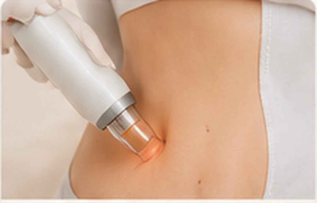 Laser Lipolysis