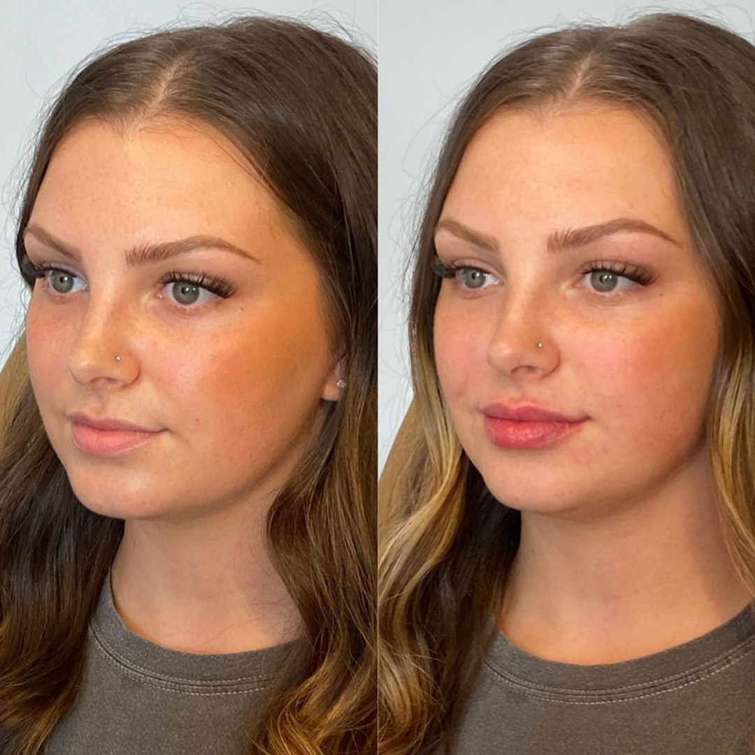 Lip Filler 3